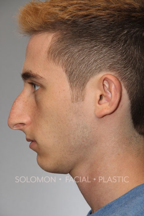 Male patient before primary rhinoplasty