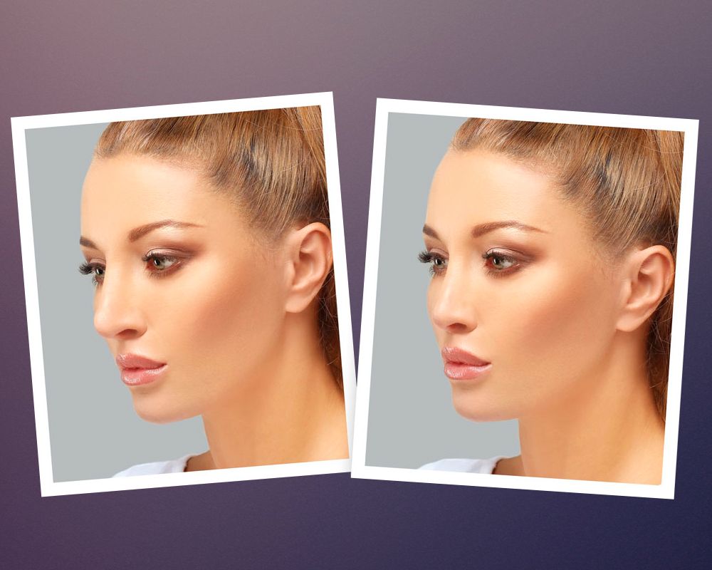 Advanced computer imaging for rhinoplasty