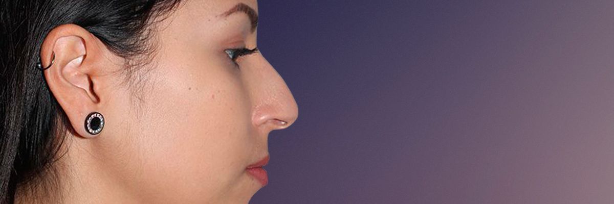 Female patient before rhinoplasty surgery