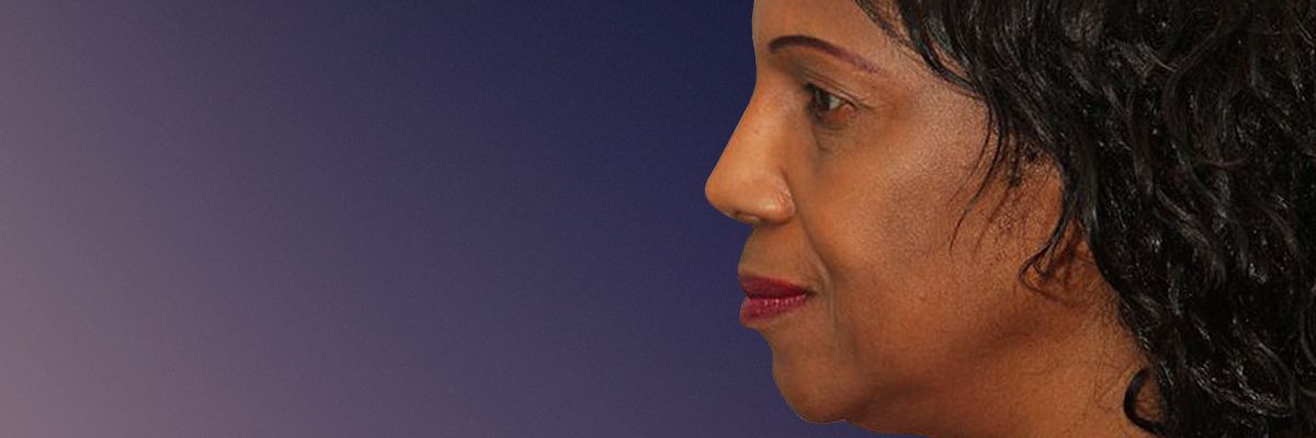 African American rhinoplasty in Toronto - After
