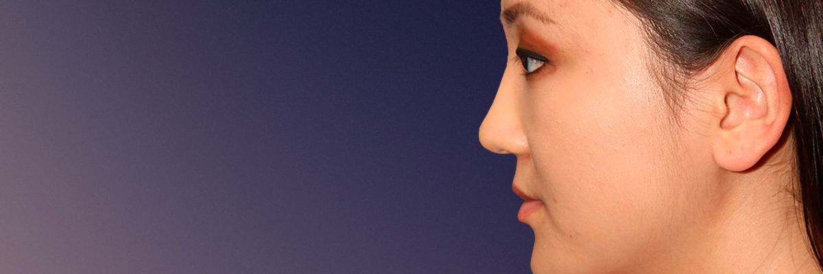 Asian patient after rhinoplasty