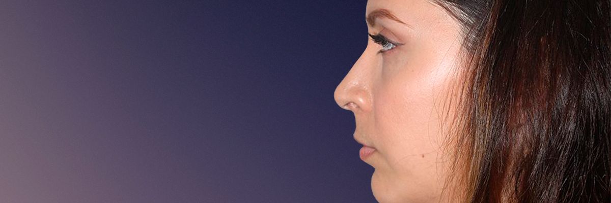 Persian patient after rhinoplasty