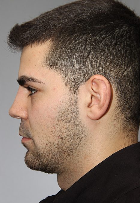 Male patient after rhinoplasty reconstruction