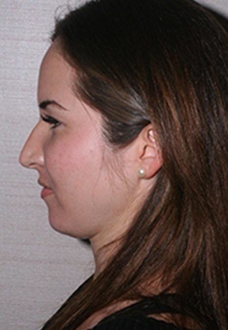 Female patient before revision rhinoplasty