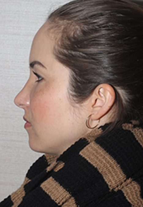 Female patient after revision rhinoplasty