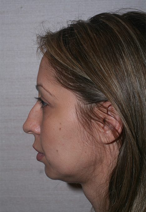 Female patient before rhino chin implant
