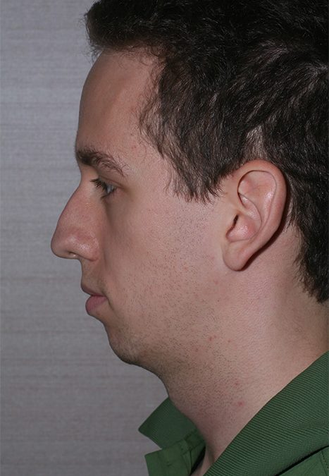 Male patient before rhino chin implant