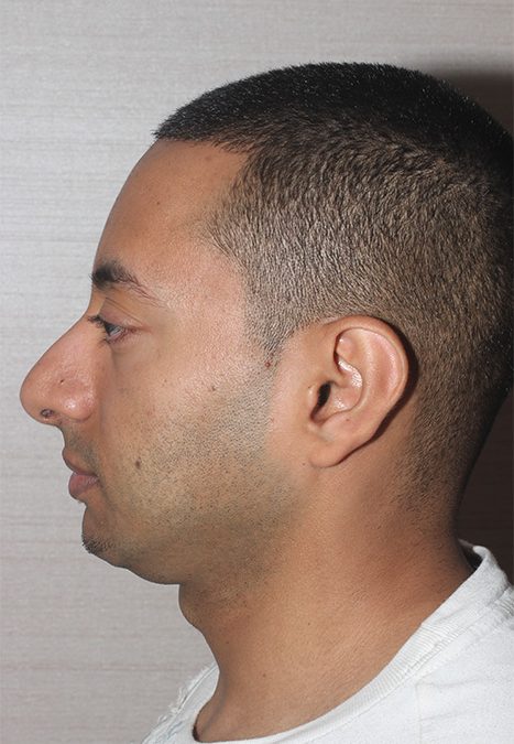 Male patient after rhino chin implant