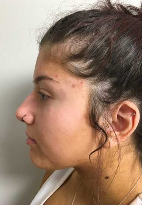 Female patient before injectable rhinoplasty
