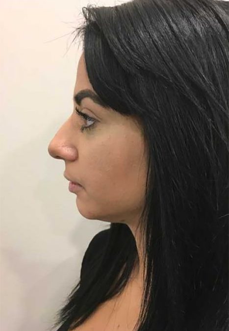 Female patient before injectable rhinoplasty