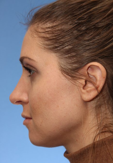 Female patient after nasal tip
