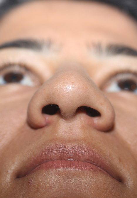 Female patient before nasal tip