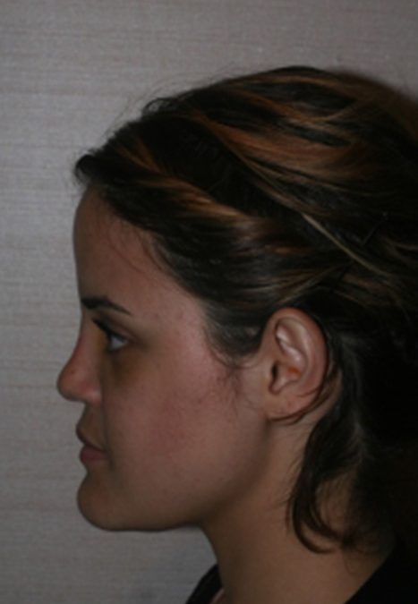 Female patient after reconstructive septorhinoplasty