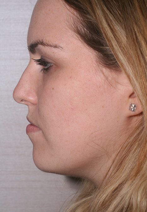 Female patient before rhinoplasty reconstruction