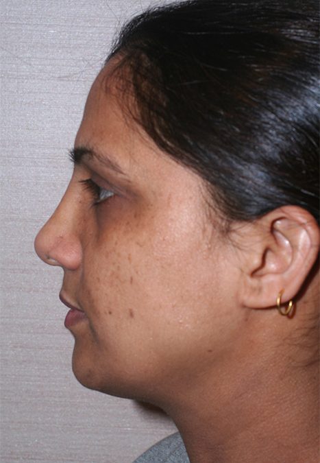 Female patient after rhinoplasty reconstruction