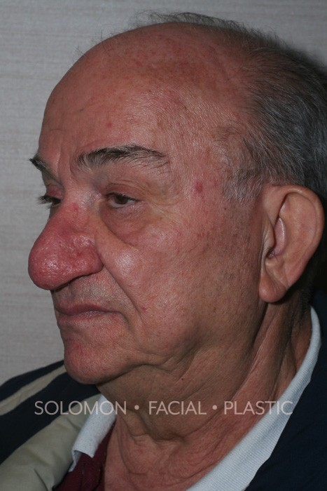 Male patient after Rhinophyma
