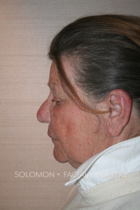 Female patient after Rhinophyma