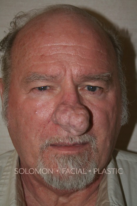 Male patient before Rhinophyma