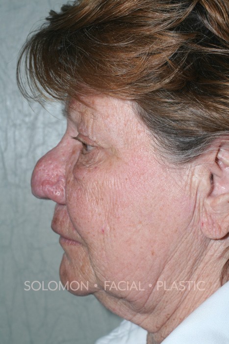 Female patient before Rhinophyma