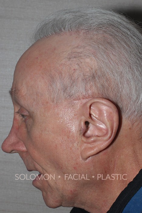 Male patient before rhinoplasty reconstruction