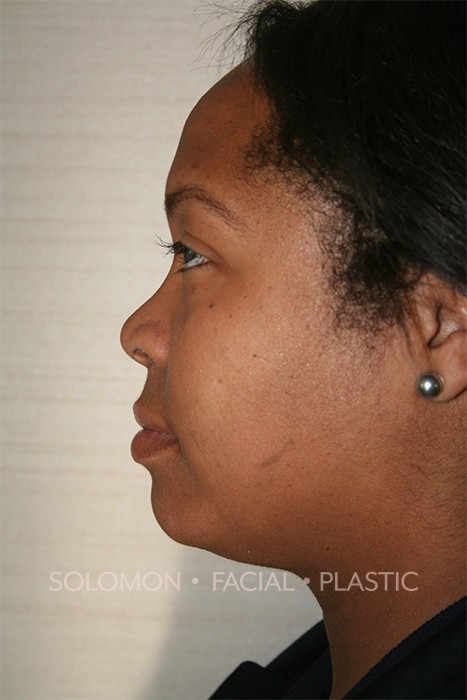 Female patient before Non Caucasian Rhinoplasty