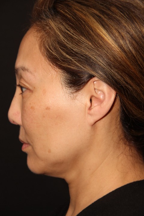 Female patient after Non Caucasian Rhinoplasty