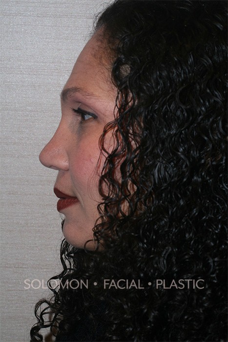 Female patient after Non Caucasian Rhinoplasty