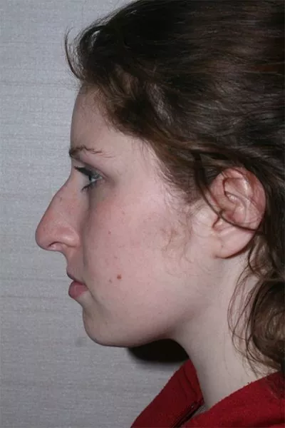 Female patient before primary rhinoplasty