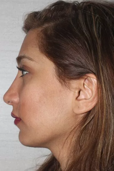 Female patient after primary rhinoplasty