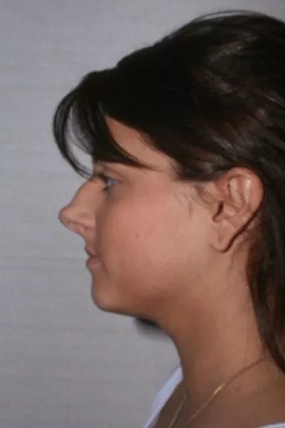 Female patient before primary rhinoplasty