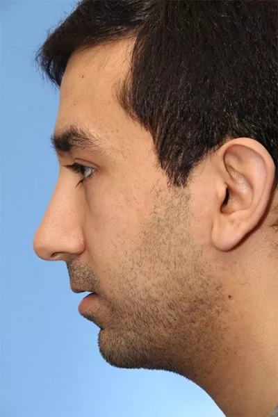 Male patient after primary rhinoplasty