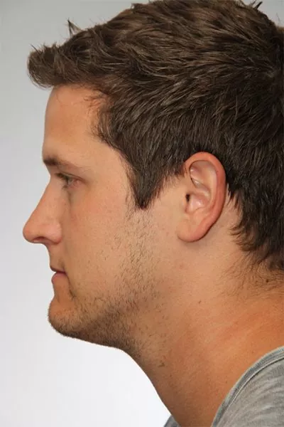Male patient after primary rhinoplasty