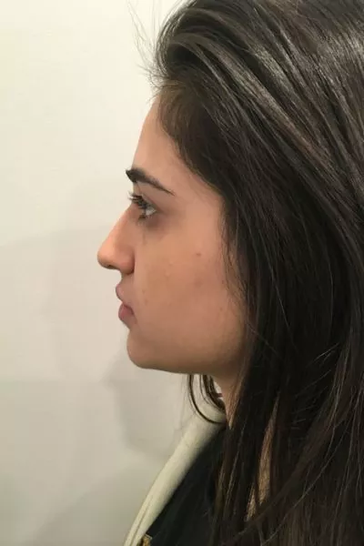 Female patient after injectable rhinoplasty