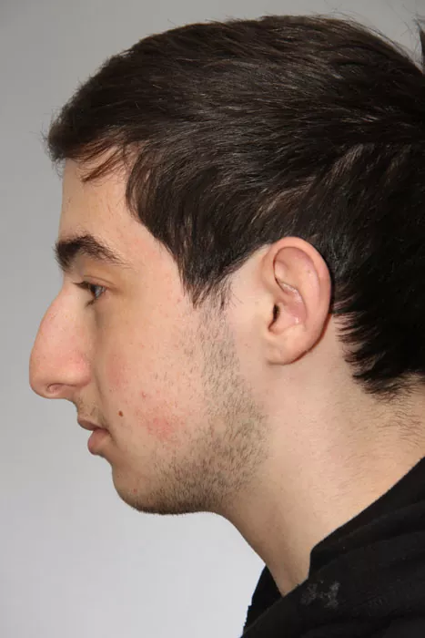 Male patient before primary rhinoplasty