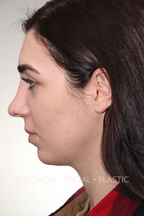 Female patient after primary rhinoplasty